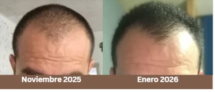 Karlos, comparativa de crecimiento de cabello noviembre 2025 a enero 2026